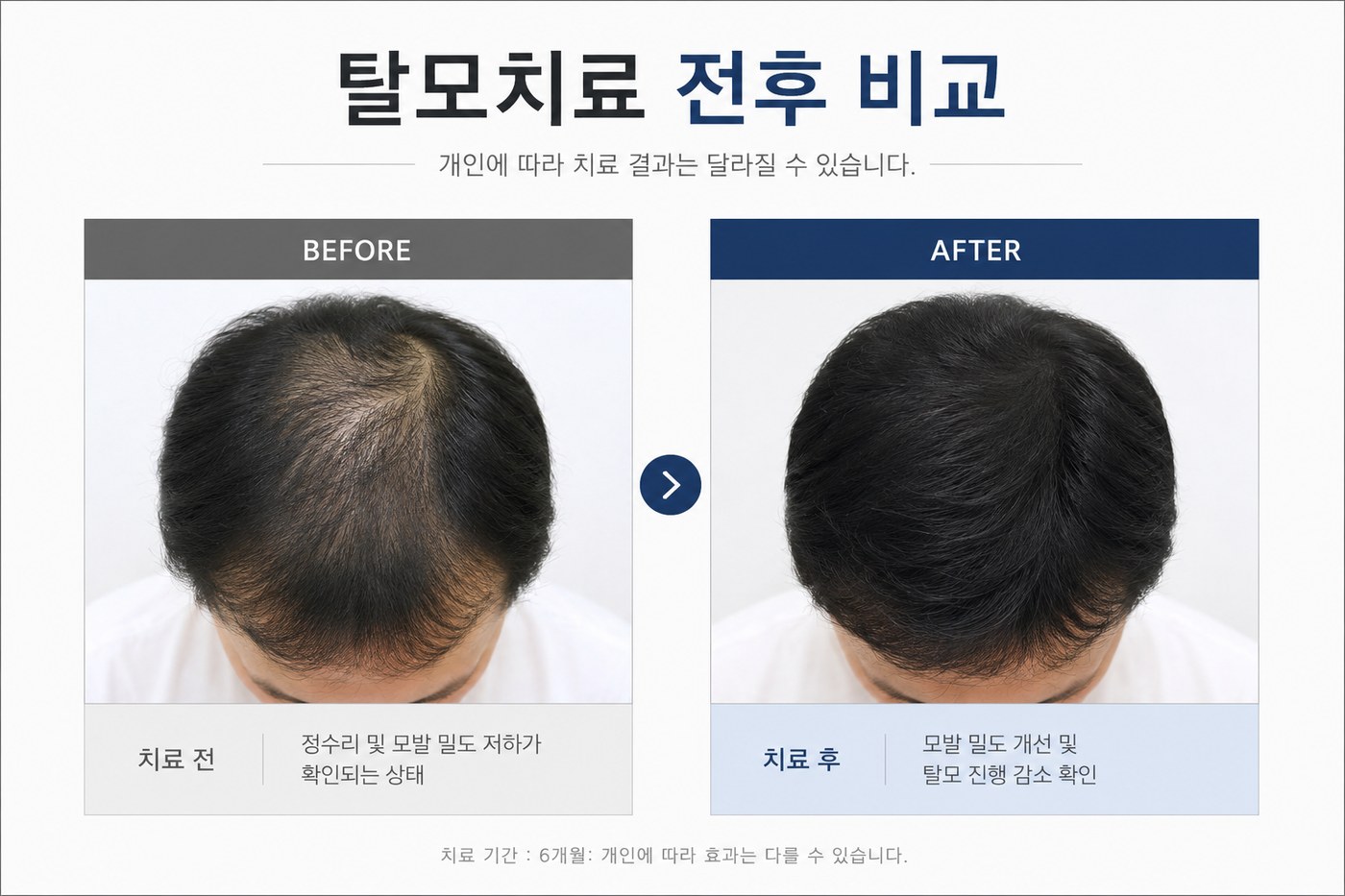 탈모치료 전후 비교