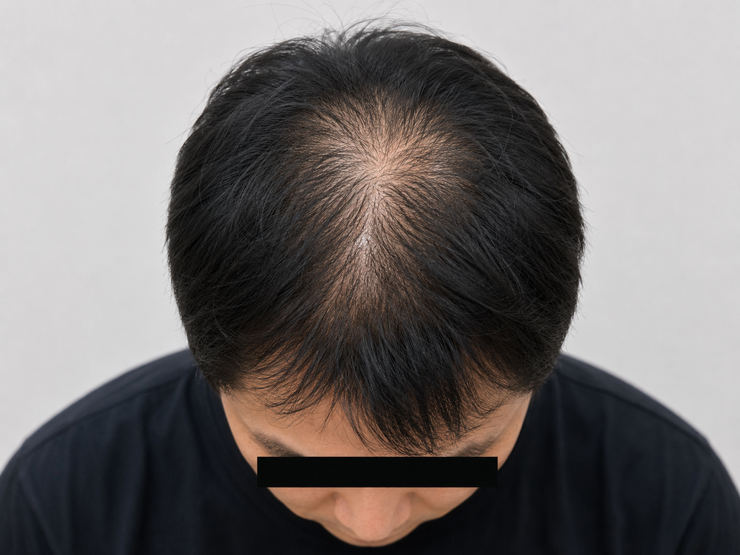 원형 탈모