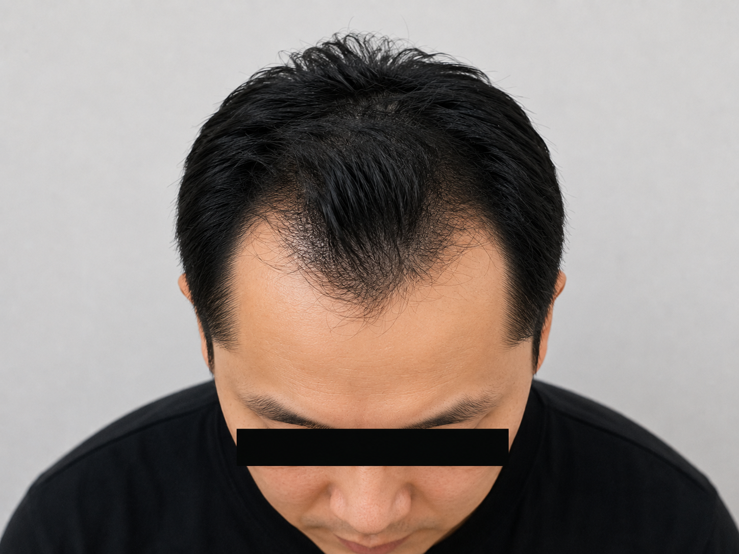 남성형 탈모
